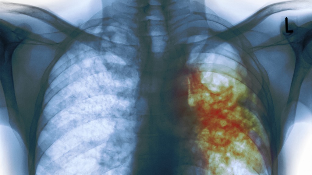 An X-ray of the chest of a man with tuberculosis. The areas infected with TB bacteria are colored red.